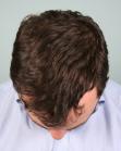 After Hair Transplant&nbsp;Front